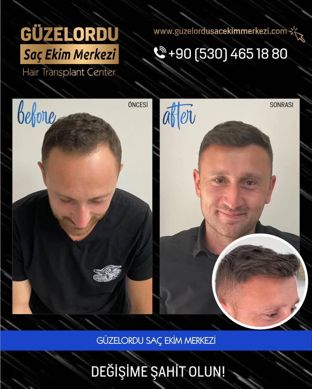 Saç ekimi öncesi ve sonrası karşılaştırması. Merkezin 25 Haziran 2025 tarihli Instagram paylaşımının özgün kapağı.